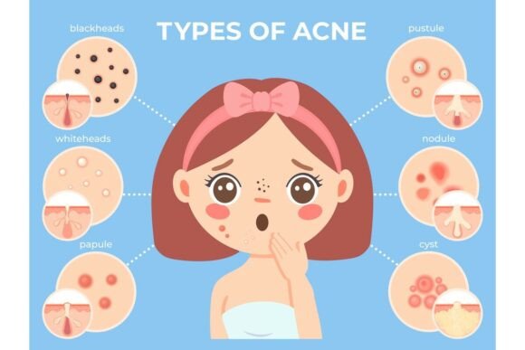 Girl with Acne. Young Unhappy Female